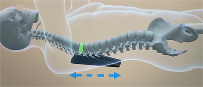 spine aligner position xray